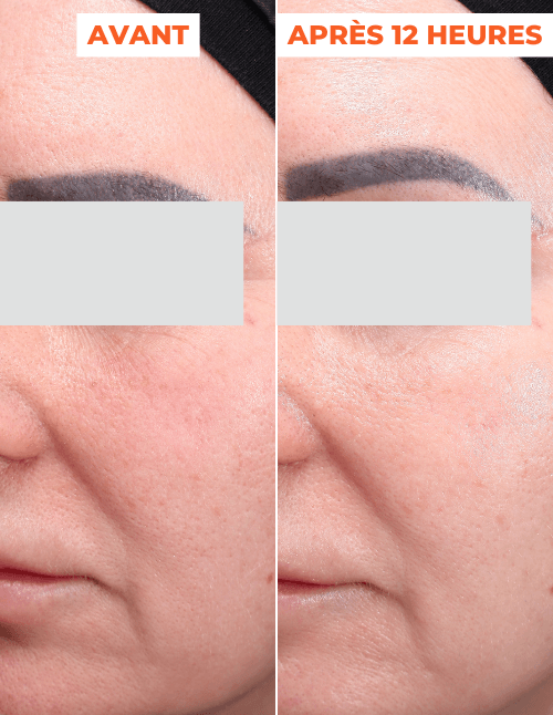 ADVANCED PEEL