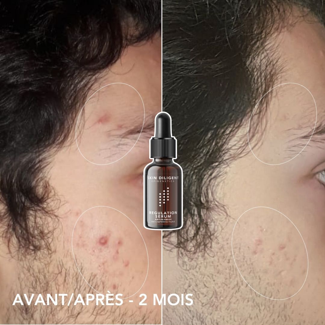 KIT ACNE
