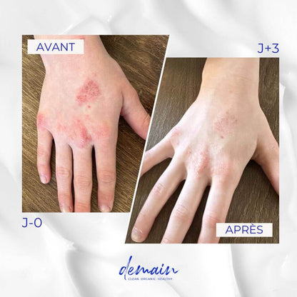 Le gel Go For Glow est efficace contre l'eczéma.