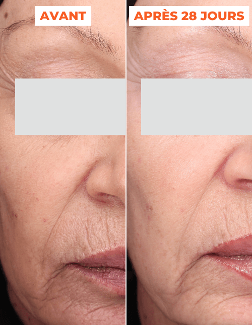 ADVANCED PEEL