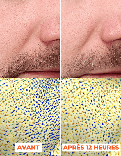 ADVANCED PEEL