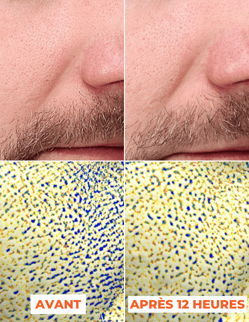 ADVANCED PEEL