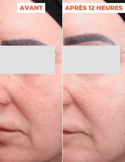 ADVANCED PEEL