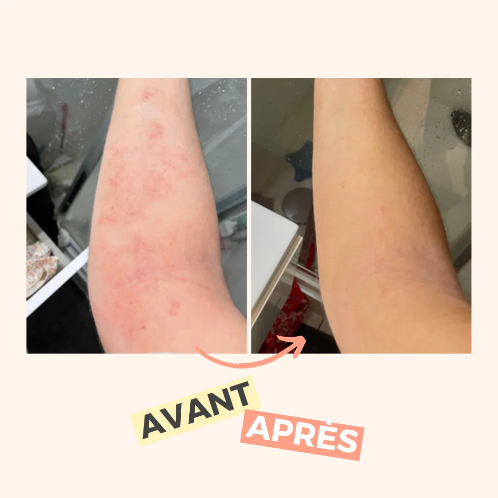 Avant Après Eczéma Solution miracle et naturelle