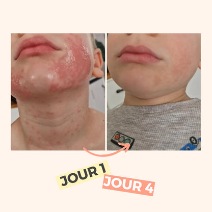 Avant Après Eczéma Solution miracle et naturelle