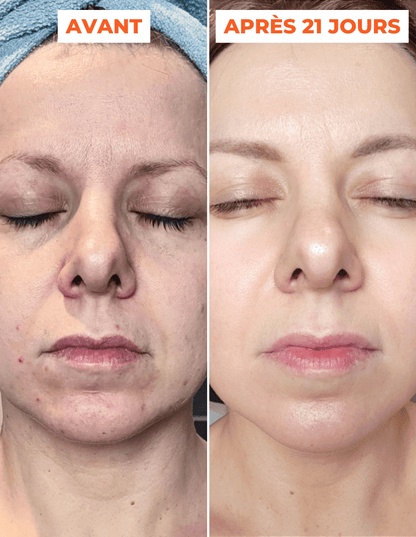 ADVANCED PEEL