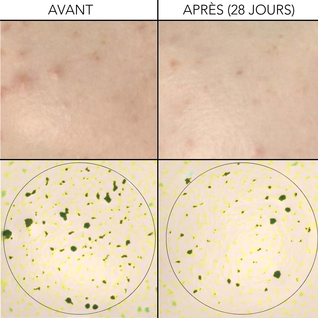KIT ACNE