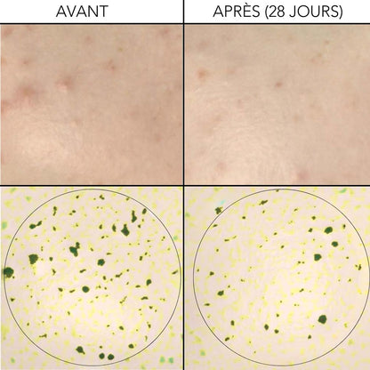 KIT ACNE